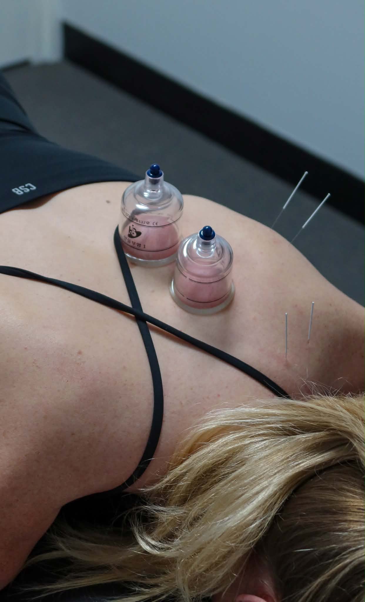 Cupping therapy at BodySync Chiropractic Stirling